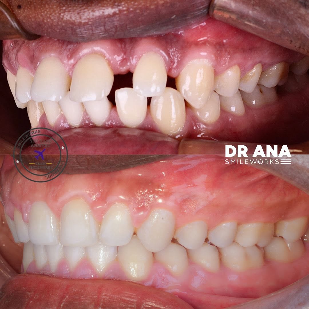 fixed braces results