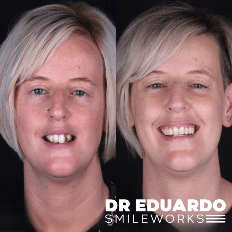 Patient case 3: before treatment on the left and after treatment on the right