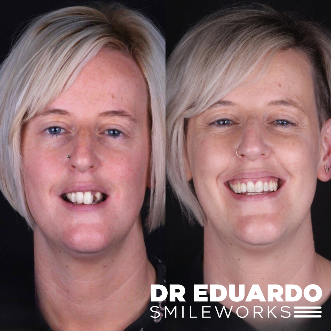 braces before and after