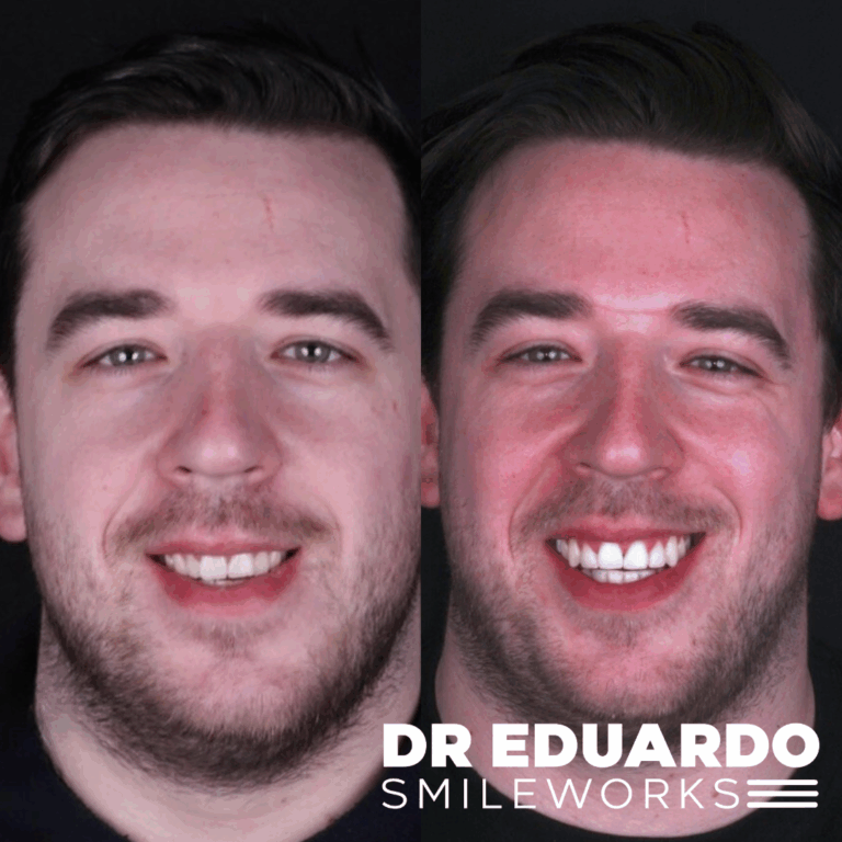 Patient case 2: before treatment on the left and after treatment on the right