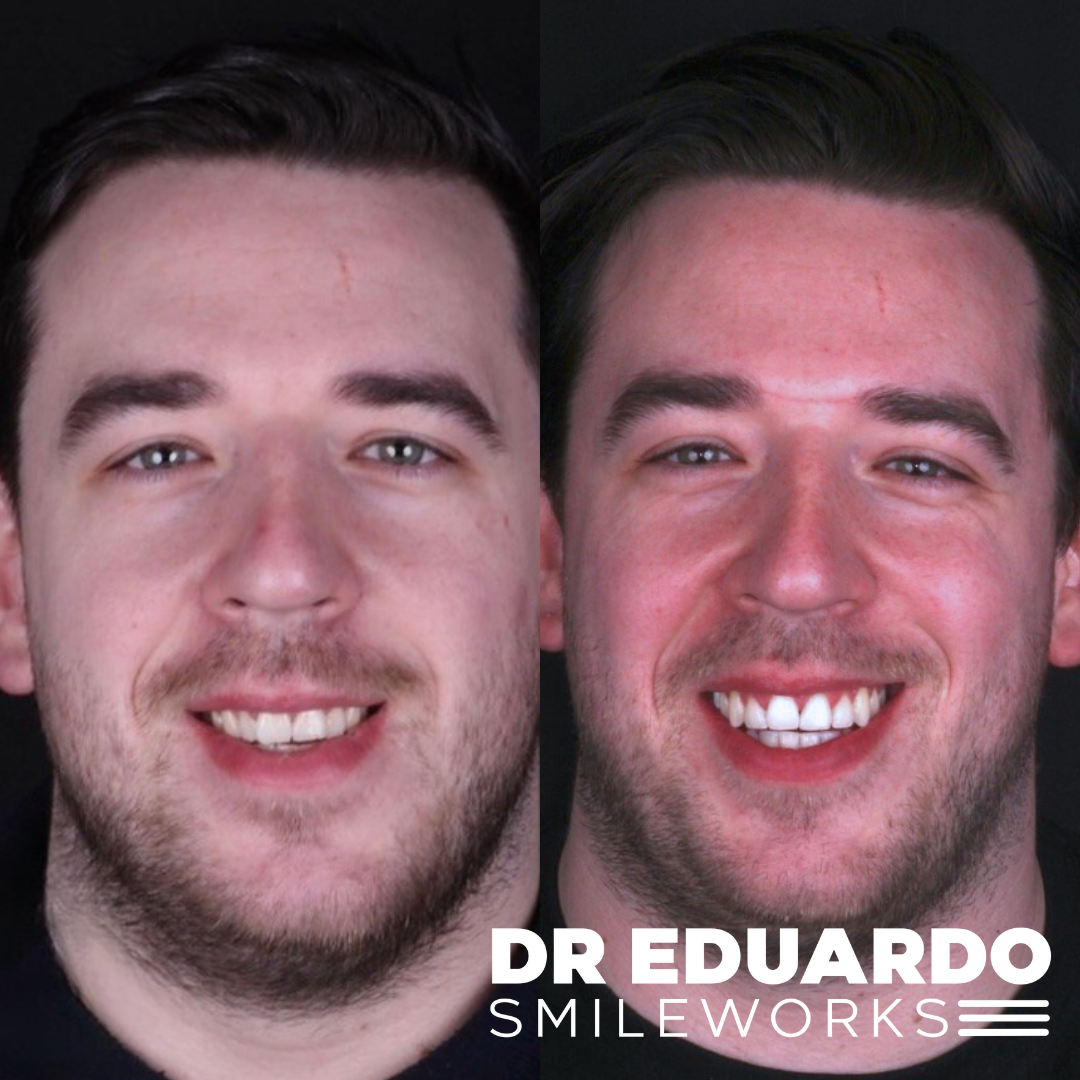 braces liverpool before and after