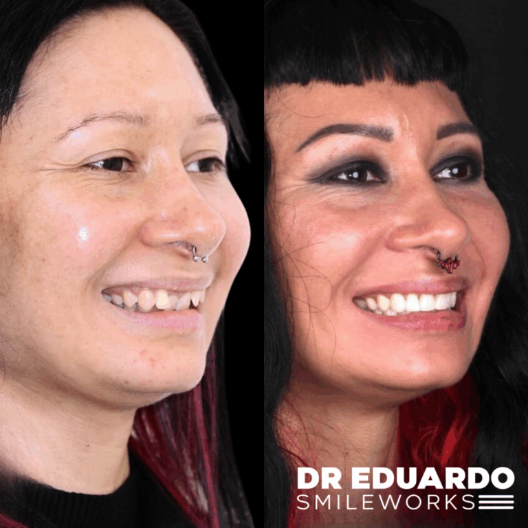 Patient case 1: before treatment on the left and after treatment on the right
