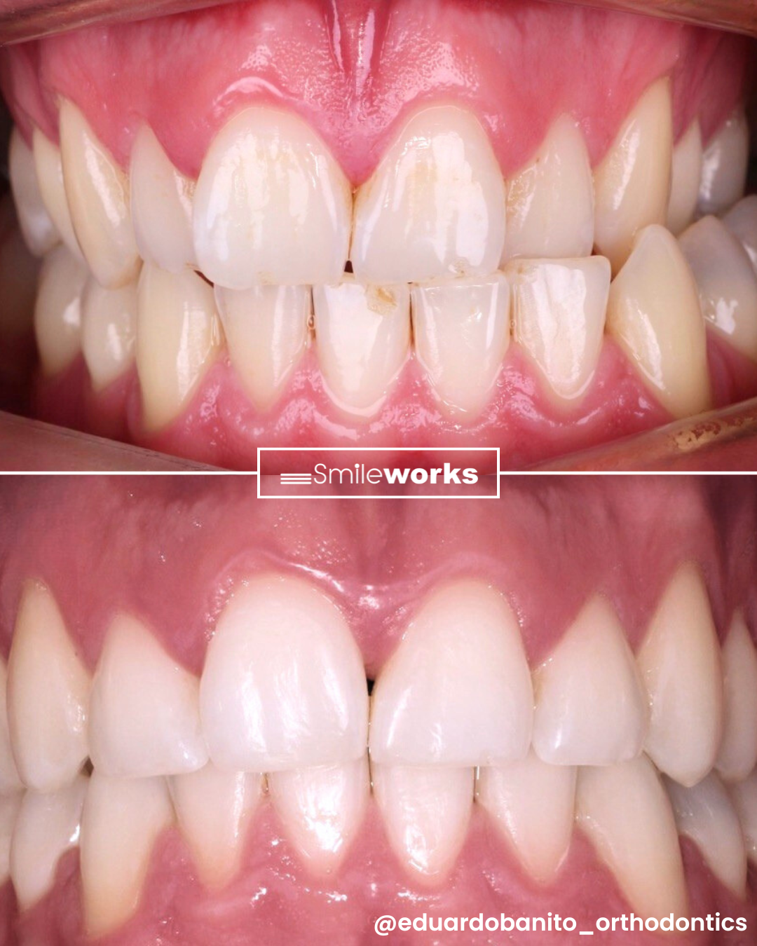 lingual braces results