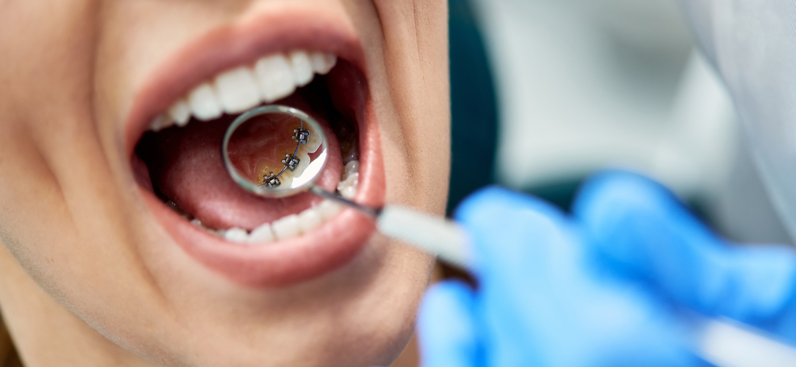 lingual braces liverpool