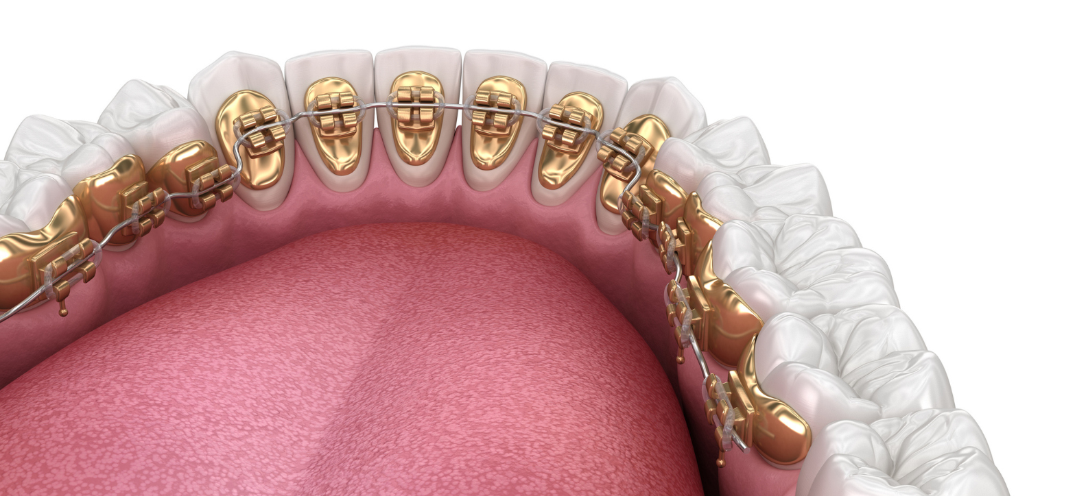 lingual braces near me