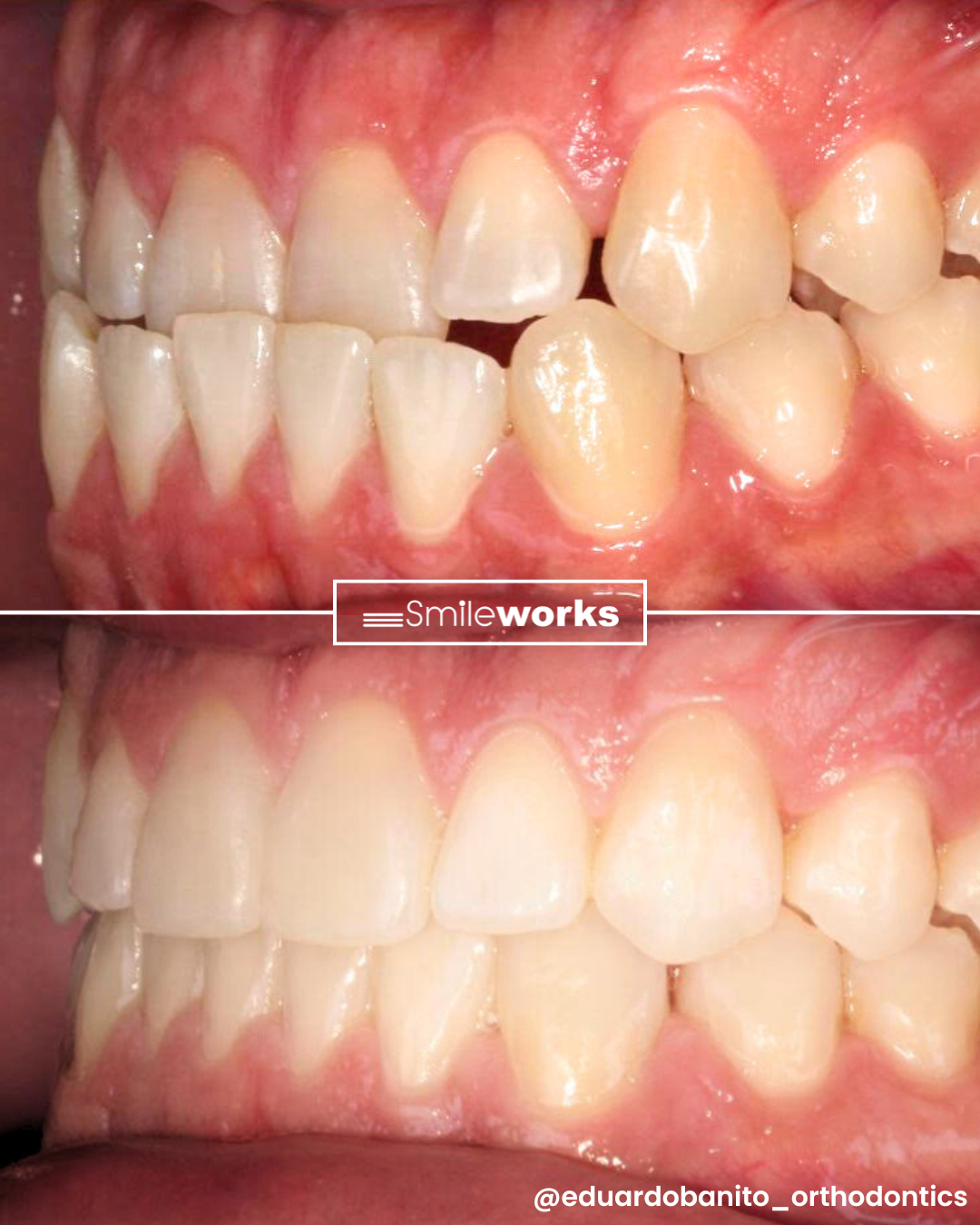 before and after invisalign