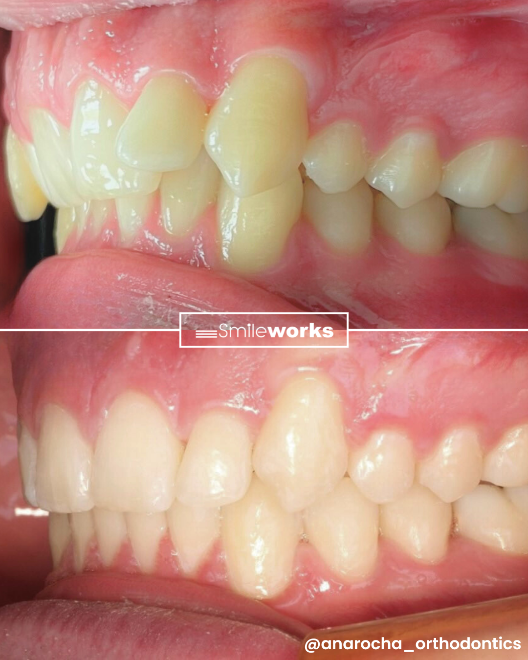 invisalign before and after