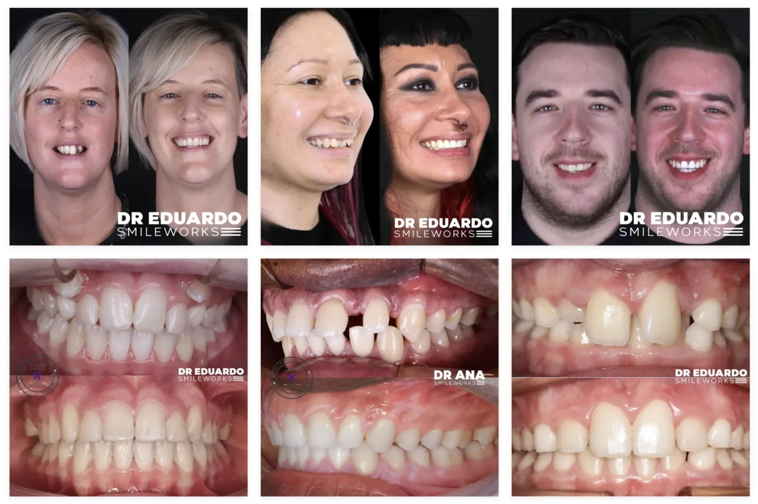 invisalign before and afters