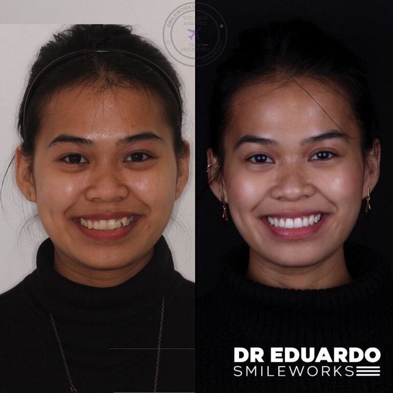 Patient case 5: before treatment on the left and after treatment on the right