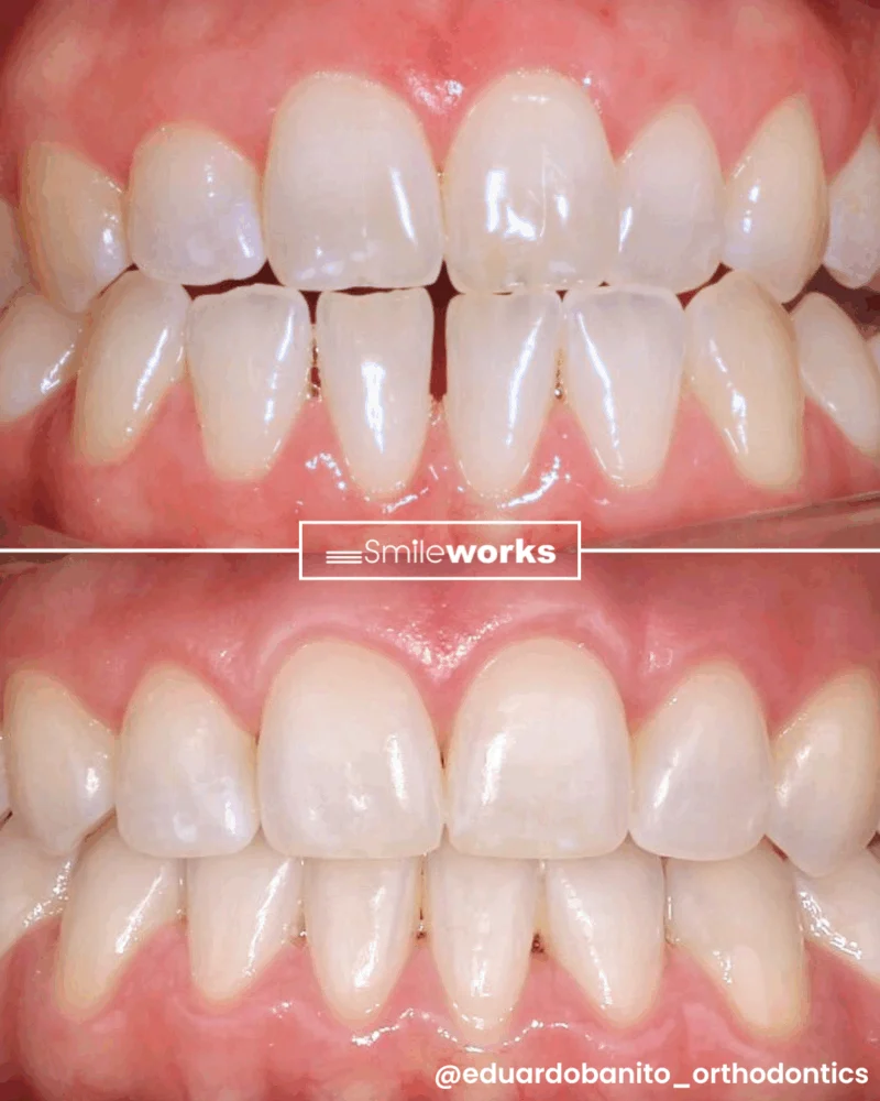 lingual braces before and after