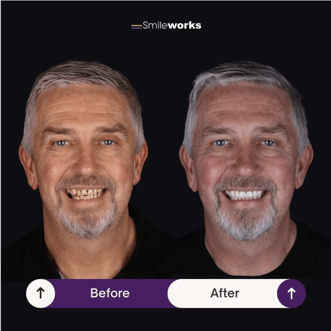 Smile makeover before and after: the same man before treatment on the left and after treatment on the right.