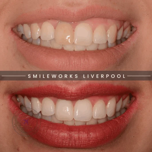 Internal whitening, Enlighten whitening and bonding before and after