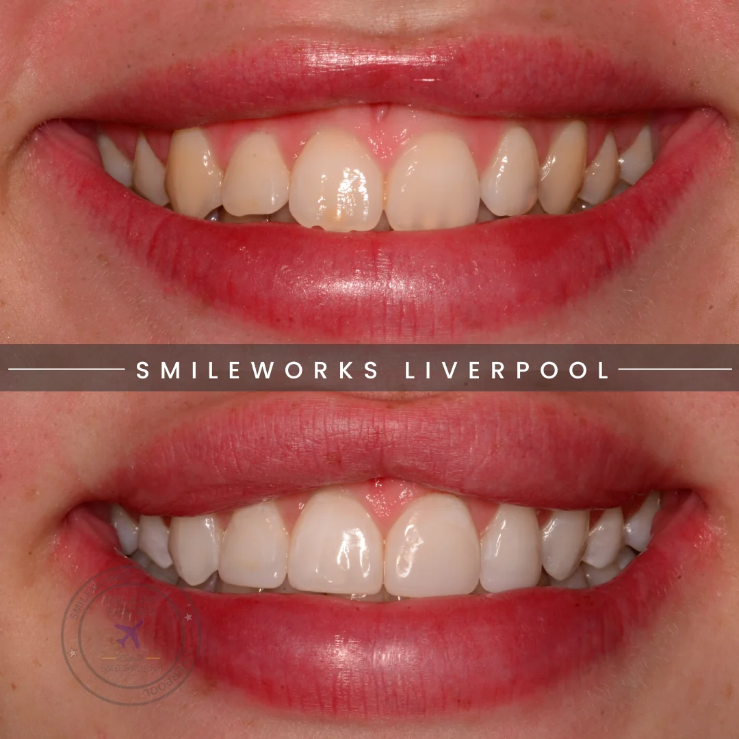 Before and after teeth whitening and bonding at Smileworks.