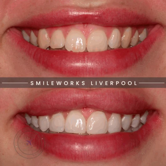 Teeth whitening and bonding before and after