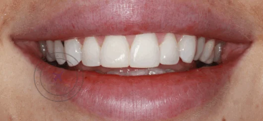 After teeth whitening at Smileworks