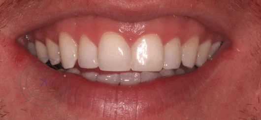 After teeth whitening at Smileworks