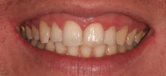 Before teeth whitening at Smileworks