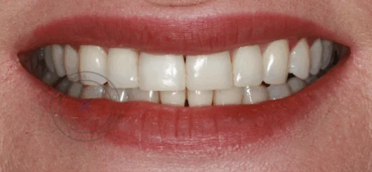 After teeth whitening at Smileworks