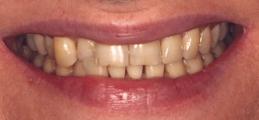 Before teeth whitening at Smileworks