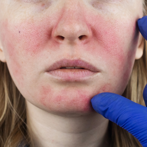 ETR rosacea