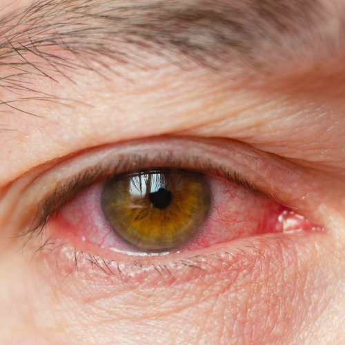 Ocular Rosacea