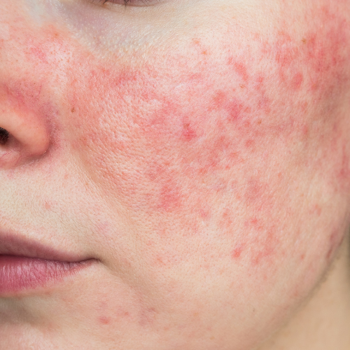 Papulopustular Rosacea