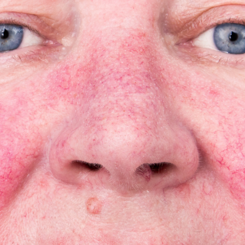 Phymatous Rosacea