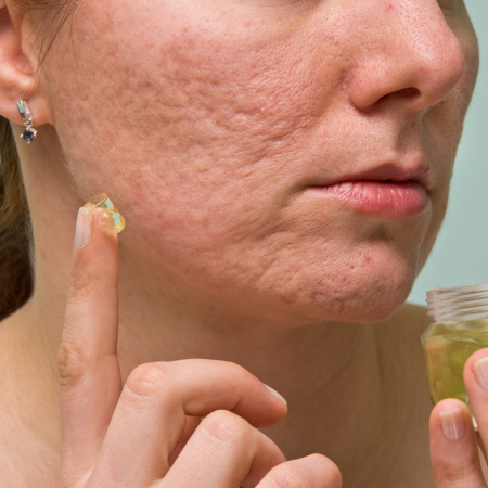 acne scar image