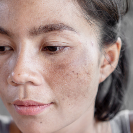 melasma page melasma page