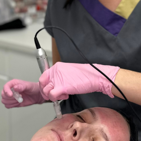 microneedling microneedling