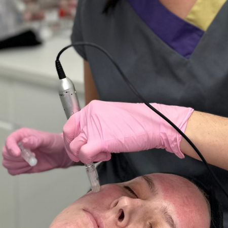 microneedling