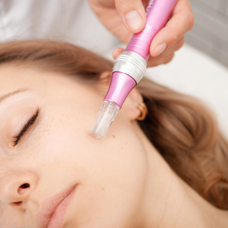 microneedling